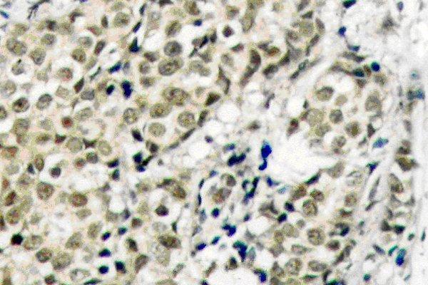 Immunohistochemistry (IHC) analyzes of AR (G207) pAb in paraffin-embedded human prostate carcinoma tissue