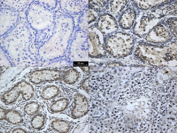 Immuno-expression of AR (A:3