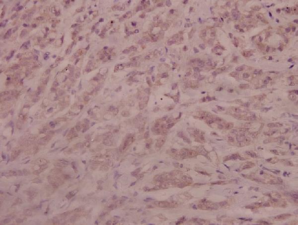 Immunohistochemistry (IHC) analyzes of p-AR (S213) pAb in paraffin-embedded human breast carcinoma tissue at 1:100