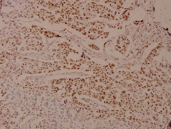 Immunohistochemistry (IHC) analyzes of p-AR (S650) pAb in paraffin-embedded human breast carcinoma tissue at 1:100