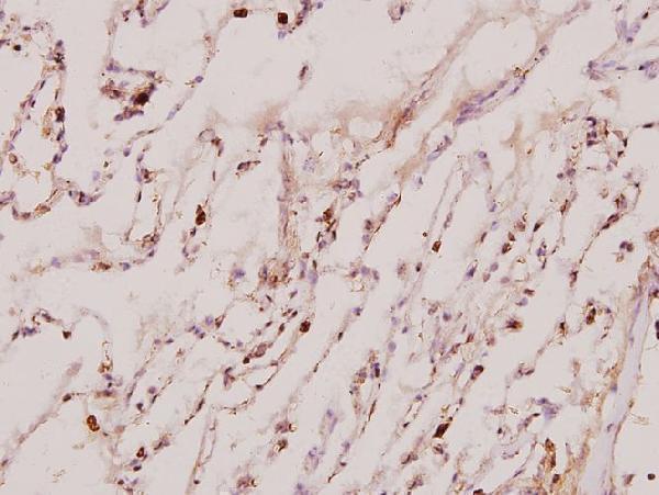 Immunohistochemistry (IHC) analyzes of Neddylin (D21) pAb in paraffin-embedded human lung carcinoma tissue at 1:100