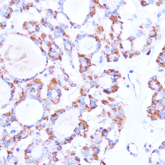 Immunohistochemistry of paraffin-embedded human thyroid cancer using ISG15 antibody  at dilution of 1:100 