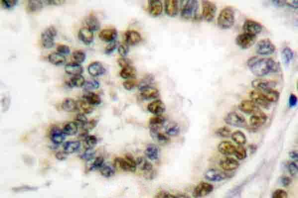Immunohistochemistry (IHC) analyzes of p-SRF (S103) pAb in paraffin-embedded human lung cancer tissue