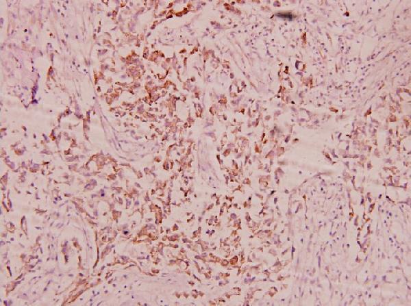 Immunohistochemistry (IHC) analyzes of FBN1 (N2843) pAb in paraffin-embedded human breast carcinoma tissue at 1:100