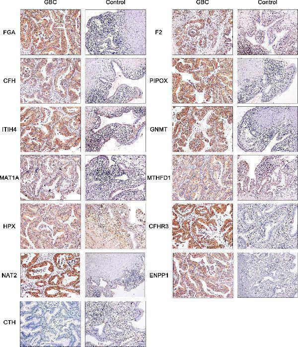Immunohistochemistry of FGA, F2, CFH, PIPOX, ITIH4, GNMT, MAT1A, MTHFD1, HPX, CTH, CFHR3, ENNP1, and NAT2 in clinical GBC and control specimens