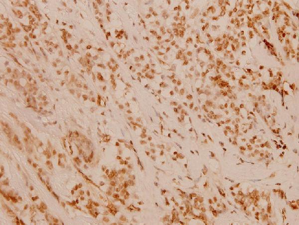 Immunohistochemistry (IHC) analyzes of FANCD2 (P216) pAb in paraffin-embedded human breast carcinoma tissue at 1:100