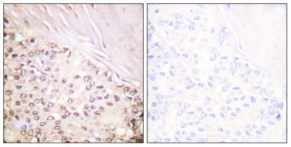 Immunohistochemistry analysis of paraffin-embedded human breast carcinoma tissue, using FANCD2 Antibody