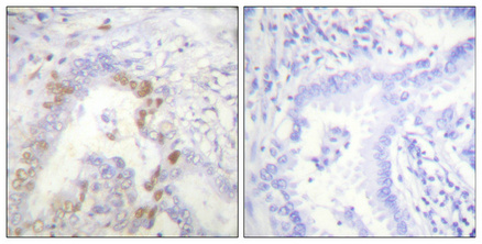 Immunohistochemical analysis of paraffin-embedded Human lung cancer