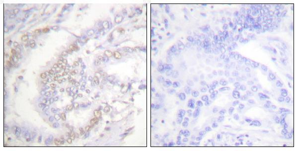 Immunohistochemistry analysis of paraffin-embedded human lung carcinoma, using FANCD2 (Phospho-Ser222) Antibody