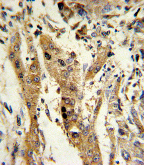 Formalin-fixed and paraffin-embedded human hepatocarcinoma reacted with GSTM1 Antibody (C-term), which was peroxidase-conjugated to the secondary antibody, followed by DAB staining