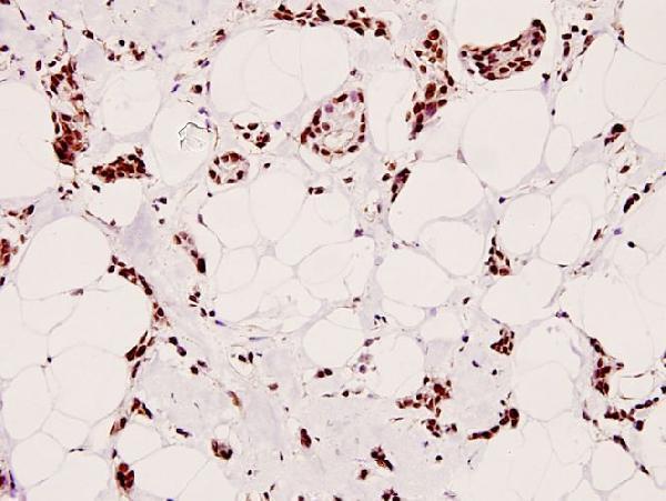 Immunohistochemistry (IHC) analyzes of p-CREB (S129) pAb in paraffin-embedded human breast carcinoma tissue at 1:100