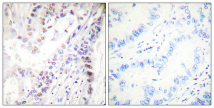 Immunohistochemical analysis of paraffin-embedded Human lung cancer