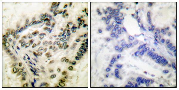 Immunohistochemistry analysis of paraffin-embedded human lung carcinoma, using CREB (Phospho-Ser142) Antibody