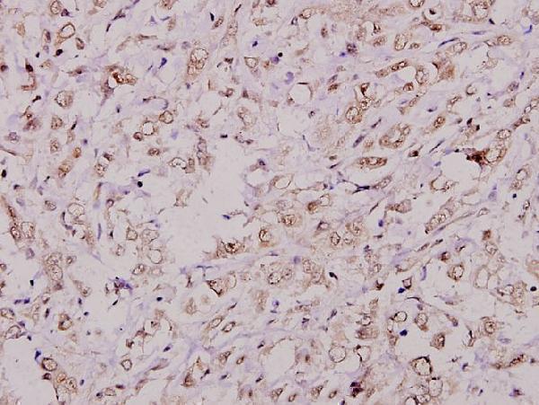 Immunohistochemistry (IHC) analyzes of p-CREB (S142) pAb in paraffin-embedded human breast carcinoma tissue at 1:100