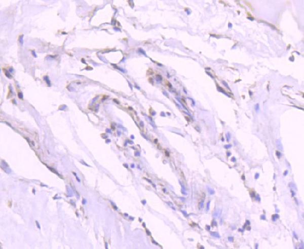 Immunohistochemical analysis of paraffin-embedded human breast carcinoma tissue using anti-Phospho-GATA3(S308) antibody