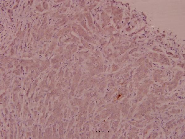 Immunohistochemistry (IHC) analyzes of ADM (N100) pAb in paraffin-embedded human breast carcinoma tissue at 1:100