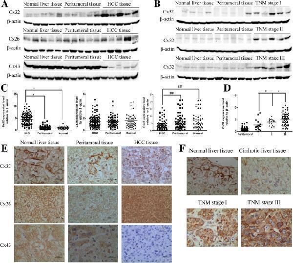 Expression and distribution of Cx32, Cx26 and Cx43 in patients with HCC