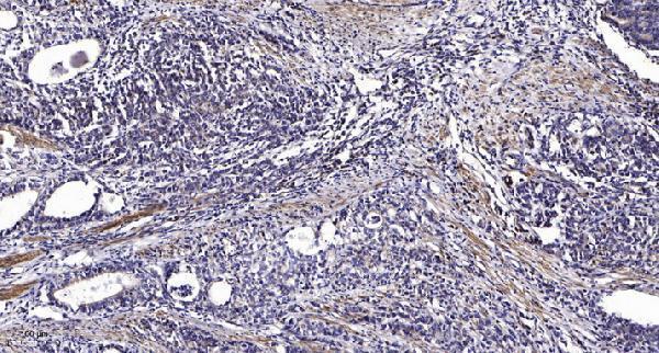 Immunohistochemical analysis of paraffin-embedded human Gastric adenocarcinoma
