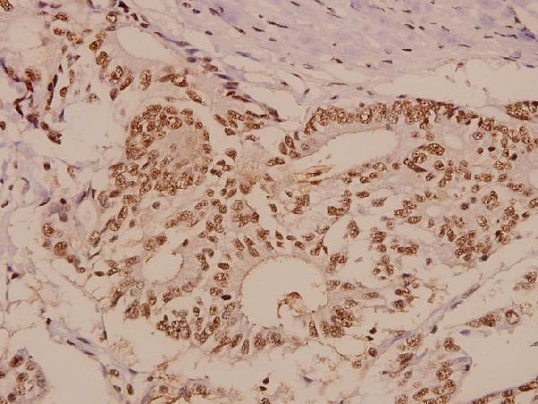 Immunohistochemistry (IHC) analyzes of PTP1B (Y46) pAb in paraffin-embedded human colorectal carcinoma tissue at 1:50