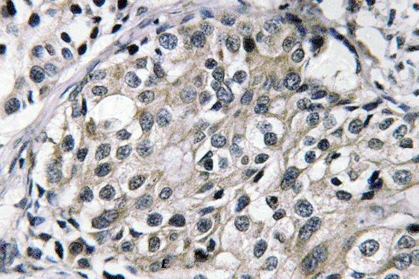 Immunohistochemistry (IHC) analyzes of TAT (E304) pAb in paraffin-embedded human breast carcinoma tissue