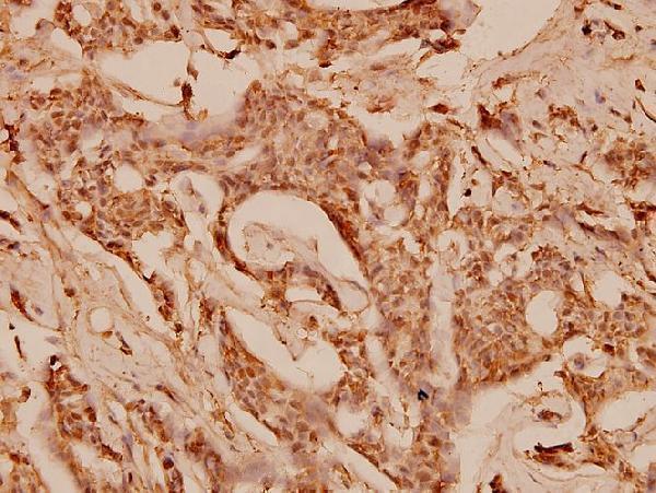 Immunohistochemistry (IHC) analyzes of COL1A2 (S3) pAb in paraffin-embedded human breast carcinoma tissue at 1:100