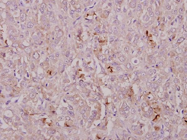 Immunohistochemistry (IHC) analyzes of COL1A2 (T501) pAb in paraffin-embedded human breast carcinoma tissue at 1:50