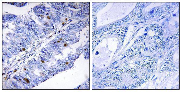 Immunohistochemistry analysis of paraffin-embedded human colon carcinoma, using Nuclear Receptor NR4A1 (Phospho-Ser351) Antibody