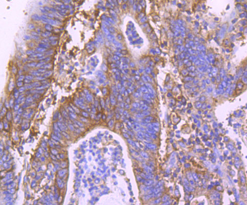 Immunohistochemical analysis of paraffin-embedded human colon cancer tissue using anti-MVP antibody