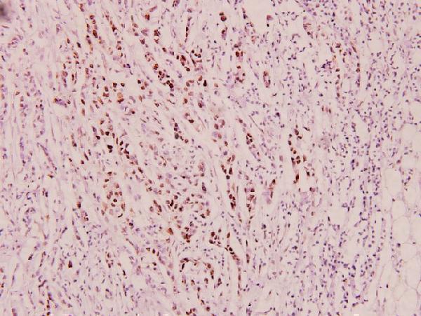 Immunohistochemistry (IHC) analyzes of p-DNA-PK (Y2609) pAb in paraffin-embedded human liver carcinoma tissue at 1:100