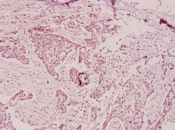 Immunohistochemistry (IHC) analyzes of Ptx3 (Y27) pAb in paraffin-embedded human breast carcinoma tissue at 1:100