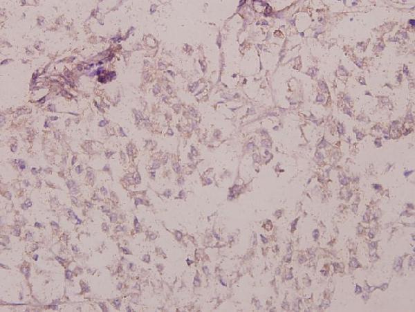 Immunohistochemistry (IHC) analyzes of p-PKAα/β cat (T197) pAb in paraffin-embedded human colorectal carcinoma tissue at 1:50