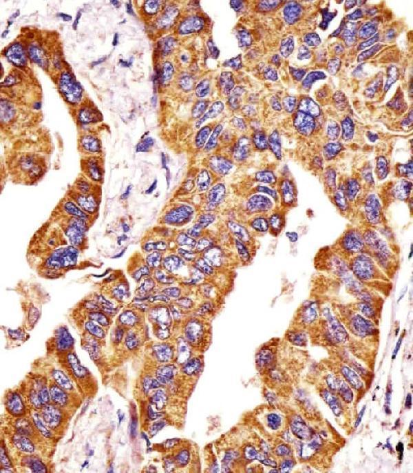A00656 staining MMP14 in human lung adenocarcinoma tissue sections by Immunohistochemistry (IHC-P -paraformaldehyde-fixed, paraffin-embedded sections)