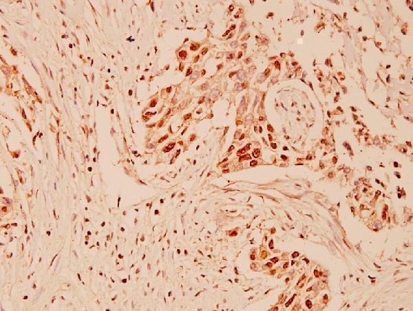 Immunohistochemistry (IHC) analyzes of CUL-1 (Y761) pAb in paraffin-embedded human breast carcinoma tissue at 1:100