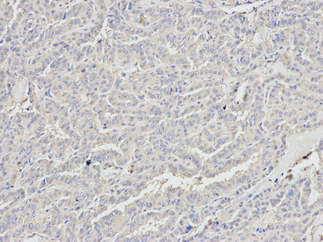 Immunohistochemistry (IHC) analysis of p68 RNA Helicase polyclonal antibody in paraffin-embedded Human Thyroid Cancer tissue