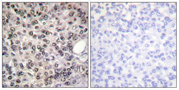 Immunohistochemistry analysis of paraffin-embedded human breast carcinoma, using DDX5/DEAD-box Protein 5 (Phospho-Tyr593) Antibody