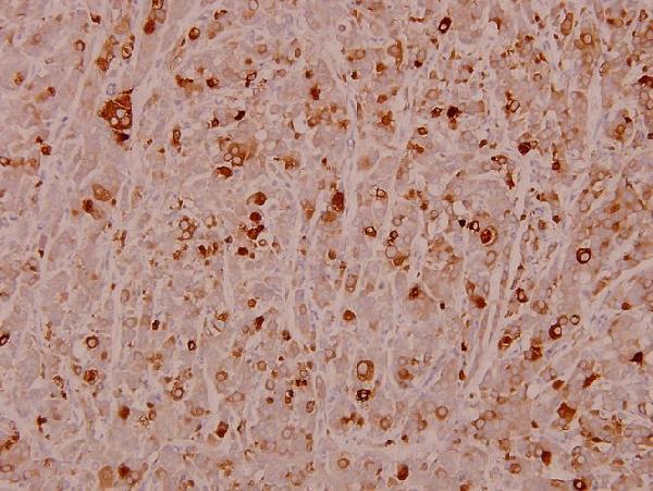 Immunohistochemistry (IHC) analyzes of p-HSP27 (S82) pAb in paraffin-embedded human breast carcinoma tissue at 1:100