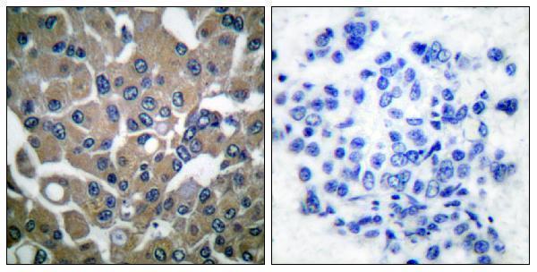 Immunohistochemistry analysis of paraffin-embedded human breast carcinoma, using PLCG1 (Phospho-Tyr783) Antibody
