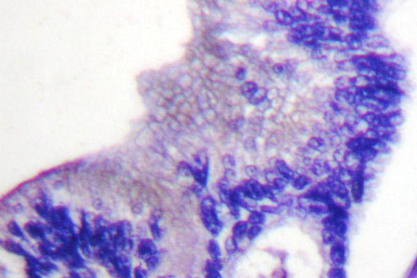 Immunohistochemistry (IHC) analyzes of p-PLCG1 (Y783) pAb in paraffin-embedded human breast carcinoma tissue