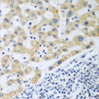 Immunohistochemistry of paraffin-embedded human liver cancer using SHBG antibody  at dilution of 1:100 