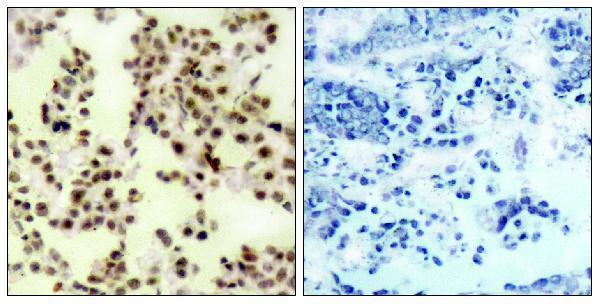 Immunohistochemistry analysis of paraffin-embedded human lung carcinoma, using p73 (Phospho-Tyr99) Antibody