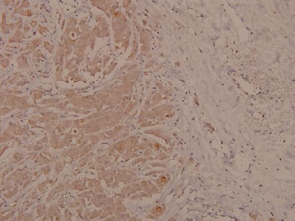 Immunohistochemistry (IHC) analyzes of p-p73 (Y99) pAb in paraffin-embedded human breast carcinoma tissue at 1:100