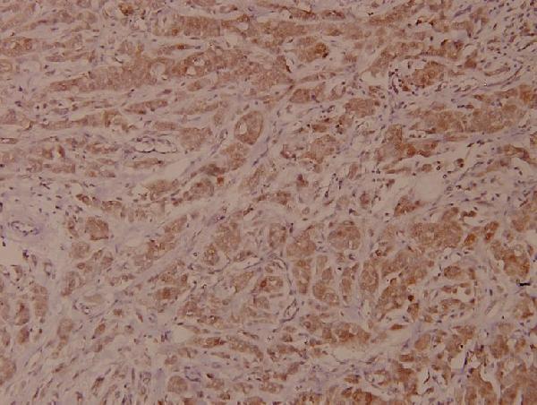 Immunohistochemistry (IHC) analyzes of VaV1 (A168) pAb in paraffin-embedded human breast carcinoma tissue at 1:100