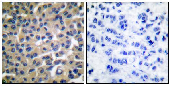 Immunohistochemistry analysis of paraffin-embedded human breast cancer, using VAV1 (Phospho-Tyr174) Antibody