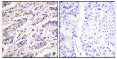 Immunohistochemical analysis of paraffin-embedded Human breast cancer