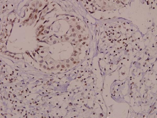 Immunohistochemistry (IHC) analyzes of p-Vav (Y174) pAb in paraffin-embedded human breast carcinoma tissue at 1:50