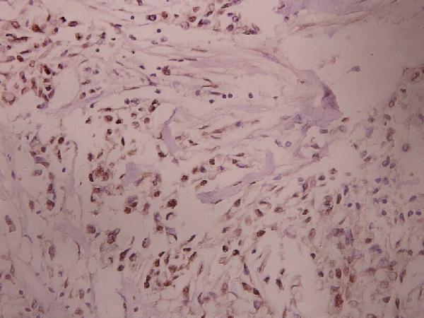 Immunohistochemistry (IHC) analyzes of PKA Iα reg (Q304) pAb in paraffin-embedded human breast carcinoma tissue at 1:100