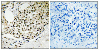 Immunohistochemical analysis of paraffin-embedded Human breast cancer