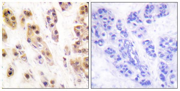Immunohistochemistry analysis of paraffin-embedded human breast carcinoma, using SSB (Phospho-Ser366) Antibody