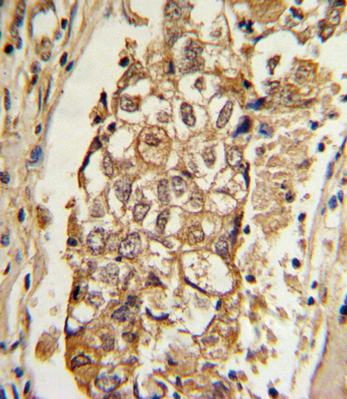 Formalin-fixed and paraffin-embedded human breast carcinoma with MCL1 Antibody (BH3 Domain Specific), which was peroxidase-conjugated to the secondary antibody, followed by DAB staining