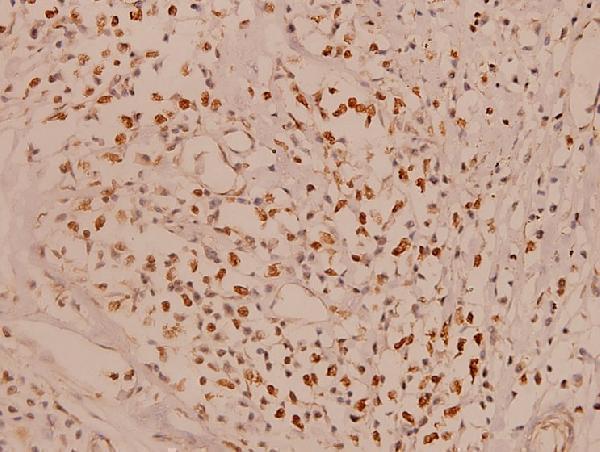 Immunohistochemistry (IHC) analyzes of Mcl-1 (S121) pAb in paraffin-embedded human breast carcinoma tissue at 1:100